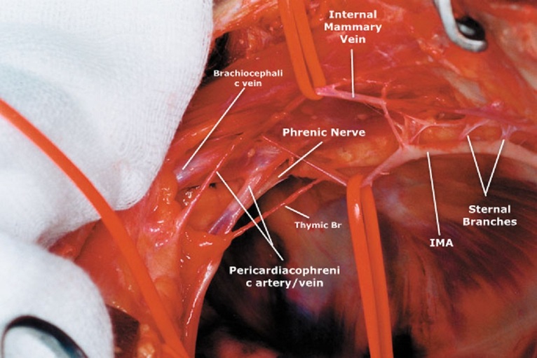 HARVESTING Internal Mammary Artery (LIMA) - CThSurgery.com