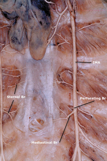 Anatomy LIMA) - CThSurgery.com